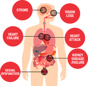 High blood pressure symptoms for women
