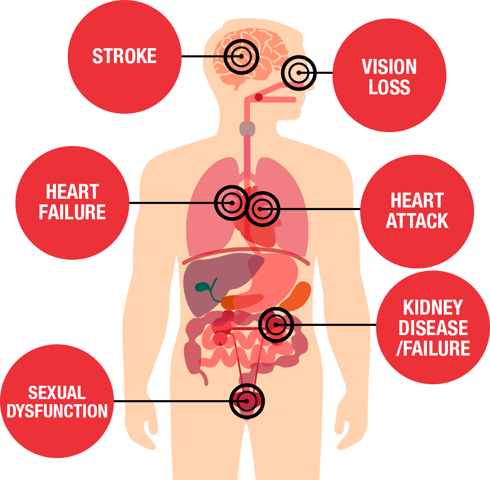 High blood pressure symptoms for women